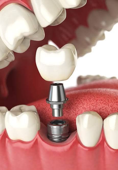 Dental Implants